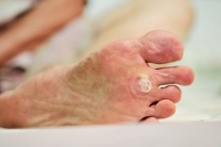 Symptoms and Causes of Plantar Warts