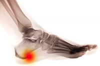 A Comprehensive Overview of Heel Spurs